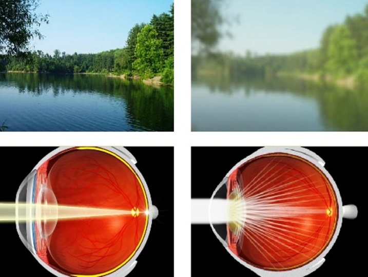 Simulare comparativă a vederii normale versus vederea afectată de cataractă