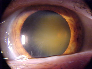 Imagine a unui ochi afectat de cataractă avansată