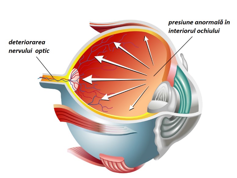 Diagrama ochiului care arată cum presiunea intraoculară crescută afectează nervul optic în glaucom Diagrama ochiului care arată cum presiunea intraoculară crescută afectează nervul optic în glaucom