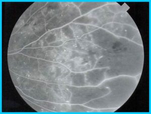 O lat imagine a unui fund de ochi în Retinopatia diabetică proliferativă forme severe O lat imagine a unui fund de ochi în Retinopatia diabetică proliferativă forme severe